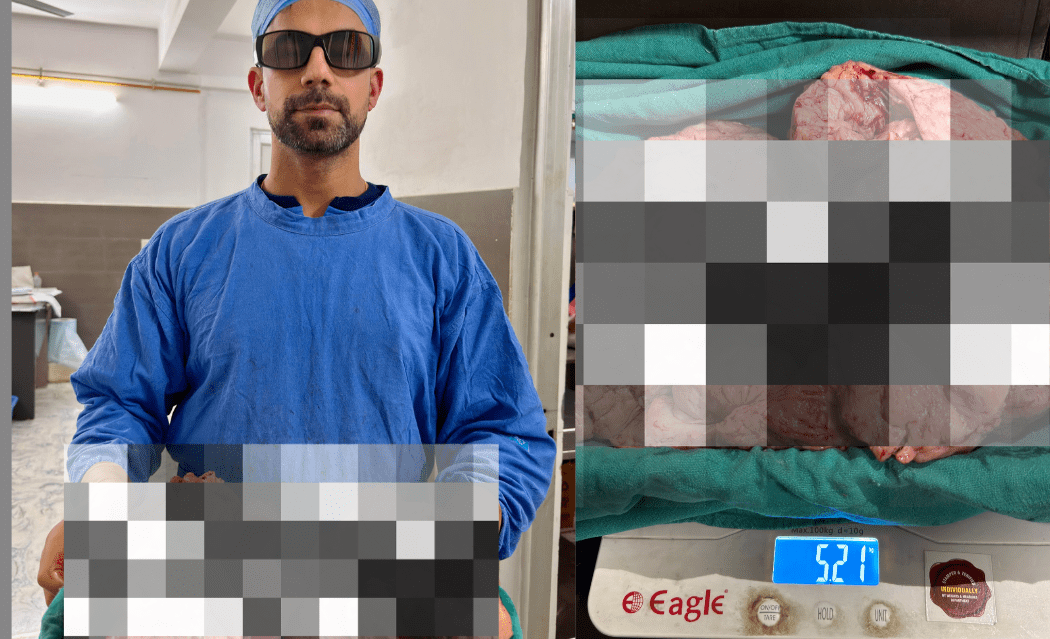 Mandi Doctors Break National Record with Landmark Laparoscopic Surgery on Giant Uterine Fibroid